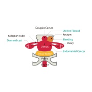 Fantoma de ultrasonido pélvico femenino US-10, US-10A, US-10B, US-10C, US-10D de Kyoto Kagaku