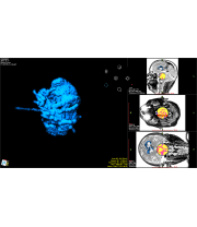 tumor